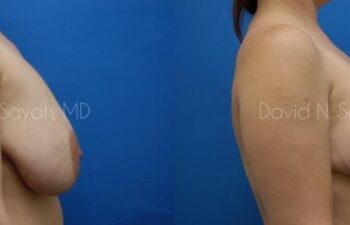 Breast Reduction Before and After | Sayah Institute