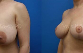 Breast Reduction Before and After | Sayah Institute