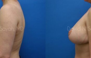 Breast Reduction Before and After | Sayah Institute