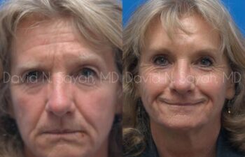 Brow Lift Before and After | Sayah Institute