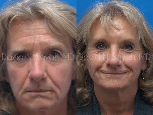 Brow Lift Before and After | Sayah Institute