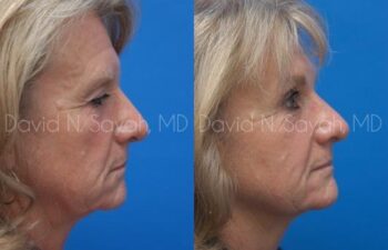Brow Lift Before and After | Sayah Institute