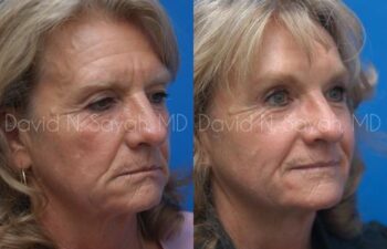 Brow Lift Before and After | Sayah Institute