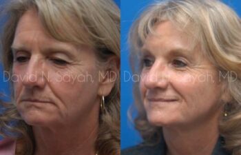 Brow Lift Before and After | Sayah Institute