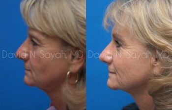 Brow Lift Before and After | Sayah Institute