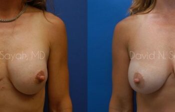 Breast Implant Exchange Before and After | Sayah Institute