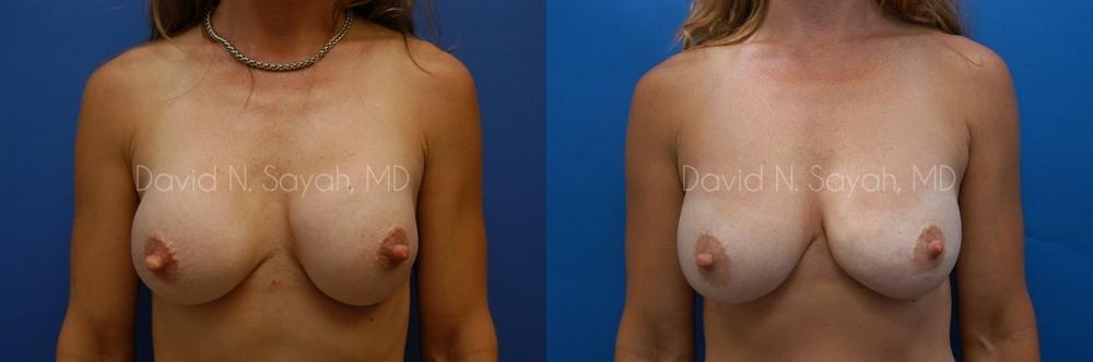 Breast Implant Exchange Before and After | Sayah Institute