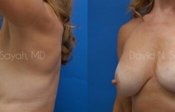 Breast Implant Exchange Before and After | Sayah Institute