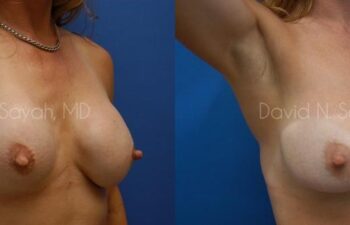 Breast Implant Exchange Before and After | Sayah Institute
