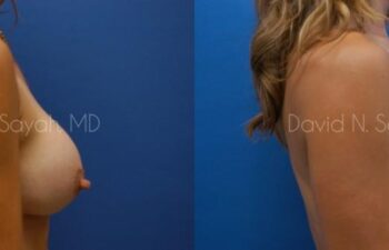 Breast Implant Exchange Before and After | Sayah Institute