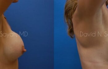 Breast Implant Exchange Before and After | Sayah Institute