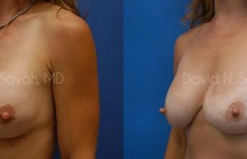 Breast Implant Exchange Before and After | Sayah Institute