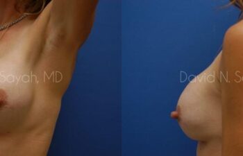 Breast Implant Exchange Before and After | Sayah Institute
