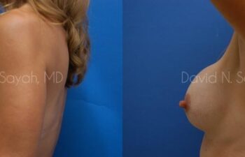 Breast Implant Exchange Before and After | Sayah Institute