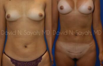 Liposuction Before and After | Sayah Institute