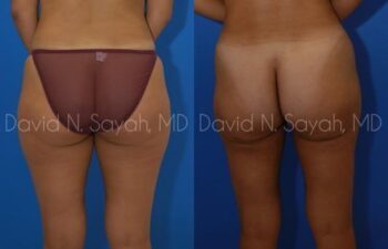 Liposuction Before and After | Sayah Institute