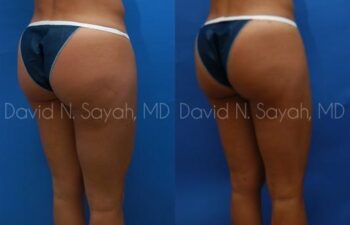 Liposuction Before and After | Sayah Institute