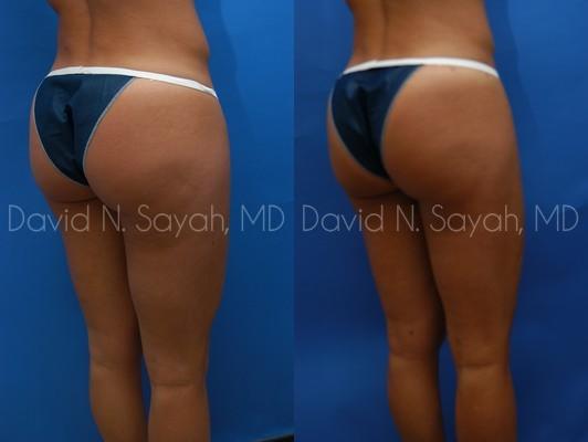 Liposuction Before and After | Sayah Institute