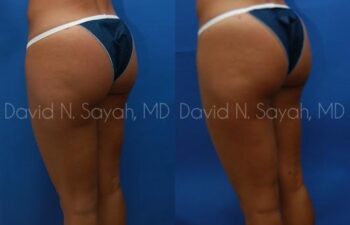 Liposuction Before and After | Sayah Institute