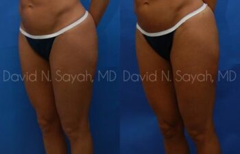 Liposuction Before and After | Sayah Institute