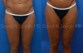 Liposuction Before and After | Sayah Institute