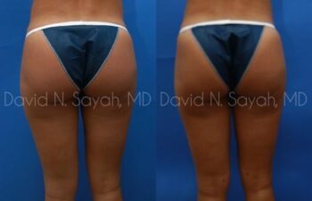 Liposuction Before and After | Sayah Institute