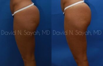 Liposuction Before and After | Sayah Institute
