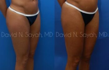 Liposuction Before and After | Sayah Institute