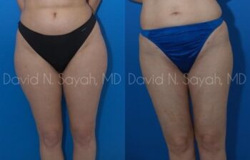 Liposuction Before and After | Sayah Institute