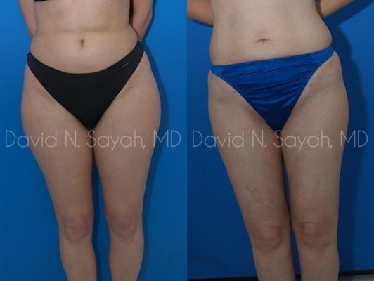 Liposuction Before and After | Sayah Institute