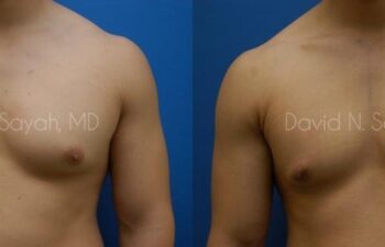 Male Breast Surgery Before and After | Sayah Institute