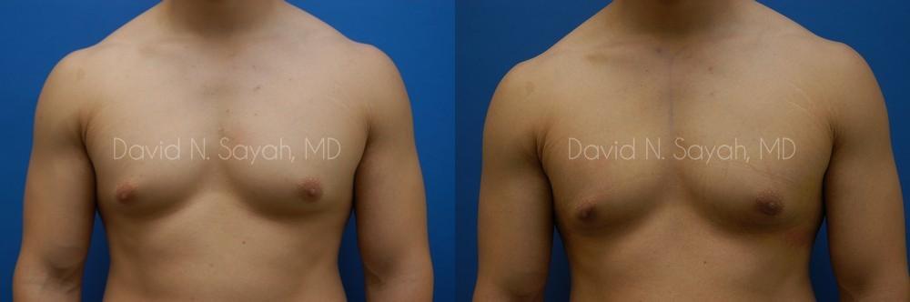 Male Breast Surgery Before and After | Sayah Institute