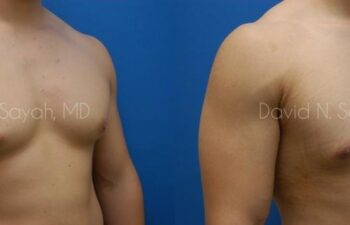 Male Breast Surgery Before and After | Sayah Institute
