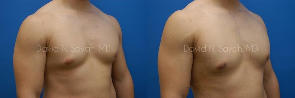 Male Breast Surgery Before and After | Sayah Institute