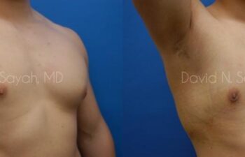 Male Breast Surgery Before and After | Sayah Institute