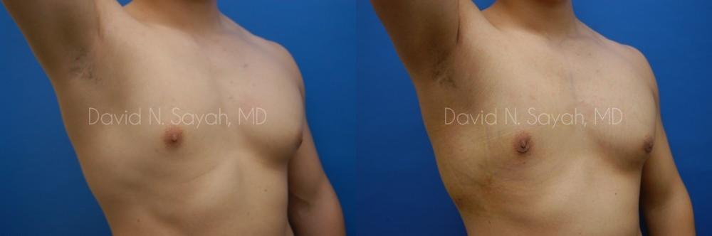 Male Breast Surgery Before and After | Sayah Institute