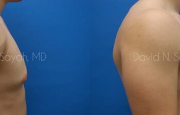 Male Breast Surgery Before and After | Sayah Institute