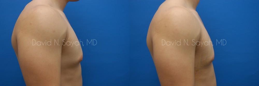 Male Breast Surgery Before and After | Sayah Institute