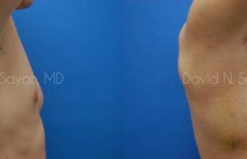 Male Breast Surgery Before and After | Sayah Institute