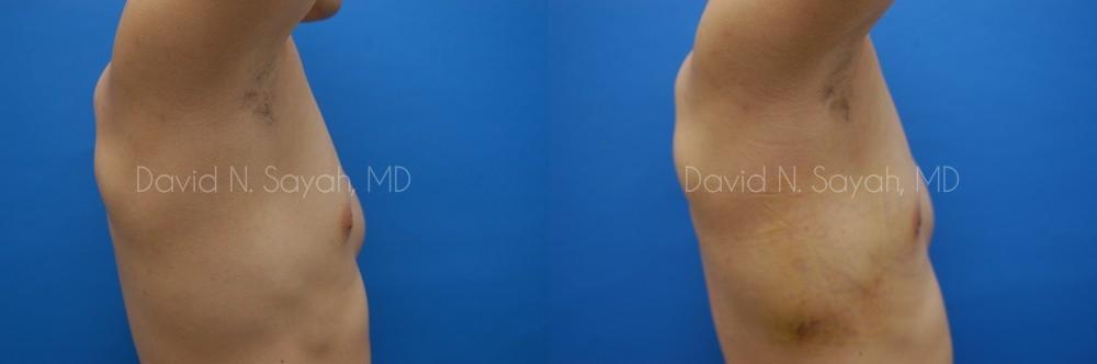Male Breast Surgery Before and After | Sayah Institute