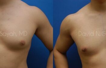 Male Breast Surgery Before and After | Sayah Institute