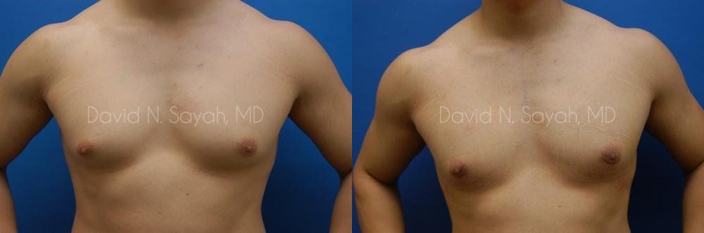 Male Breast Surgery Before and After | Sayah Institute