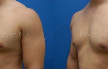 Male Breast Surgery Before and After | Sayah Institute