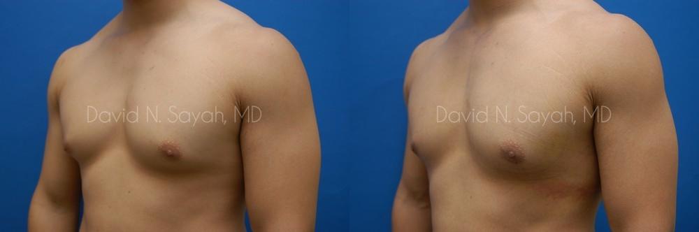 Male Breast Surgery Before and After | Sayah Institute