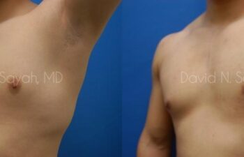 Male Breast Surgery Before and After | Sayah Institute