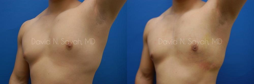 Male Breast Surgery Before and After | Sayah Institute