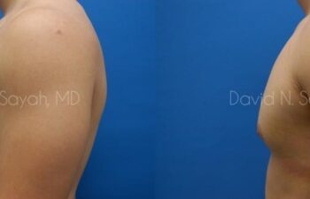 Male Breast Surgery Before and After | Sayah Institute