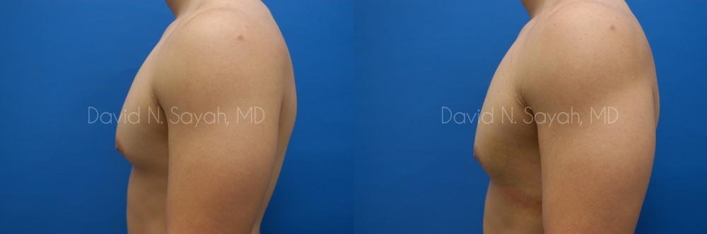 Male Breast Surgery Before and After | Sayah Institute