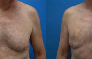 Male Breast Surgery Before and After | Sayah Institute