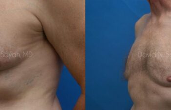 Male Breast Surgery Before and After | Sayah Institute